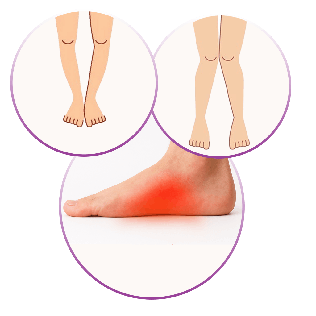 کف پای صاف و پای پرانتزی