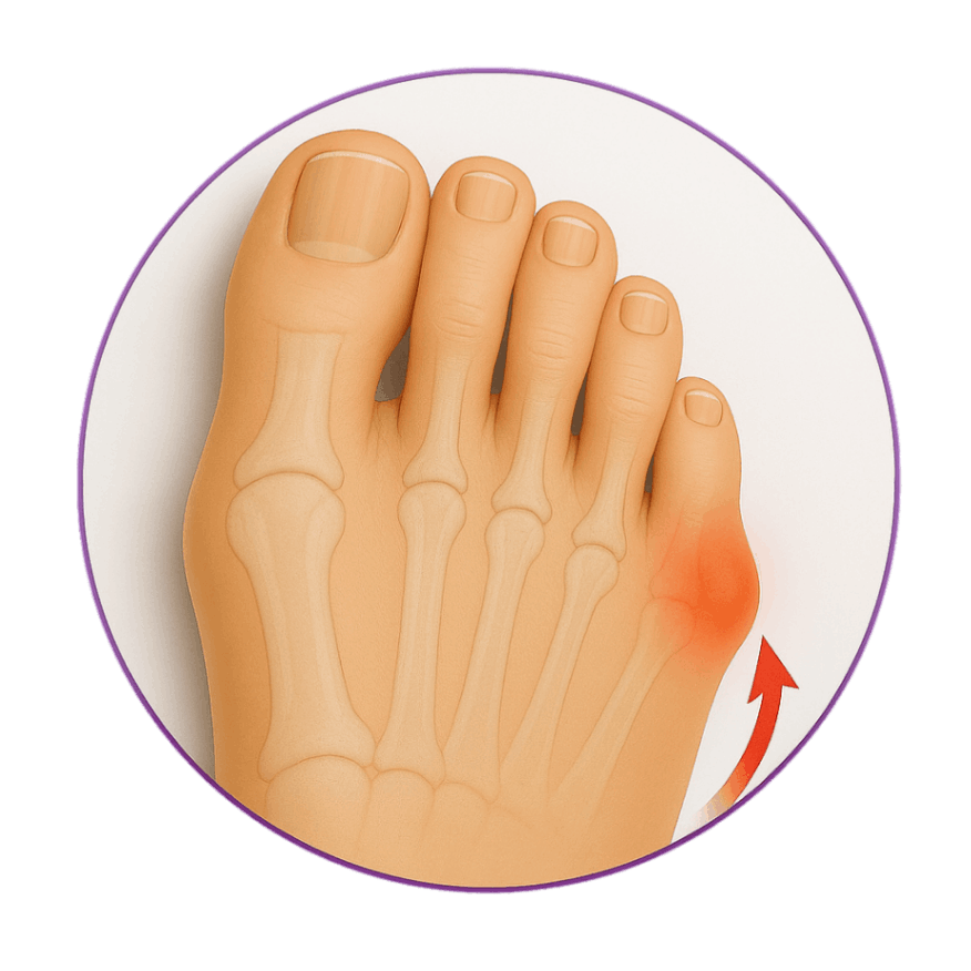 انحراف انگشت کوچک پا